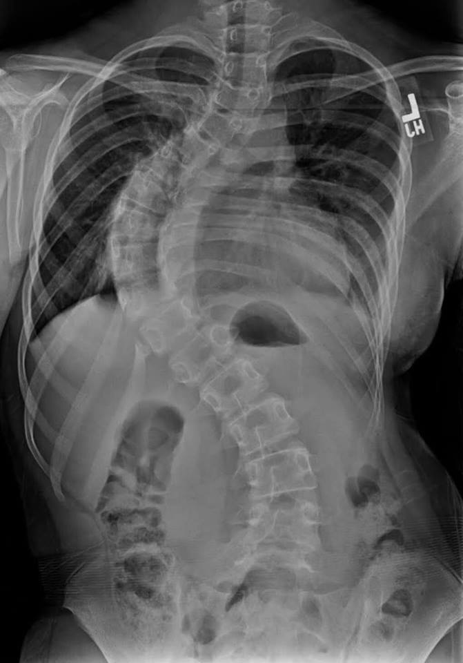 What is Scoliosis? The Orthopaedic Specialists of Louisville