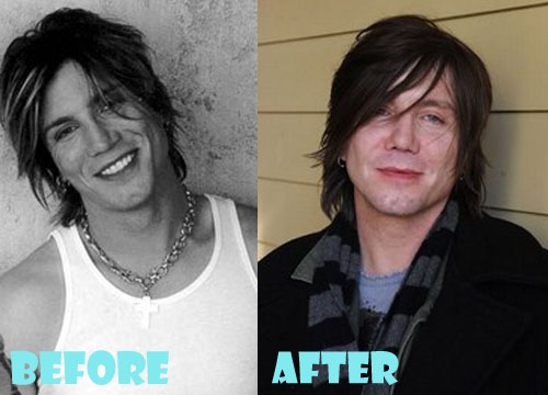 John Rzeznik Plastic Surgery Before and After Picture Lovely Surgery