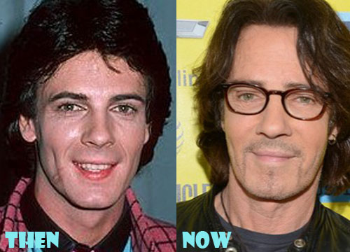 Rick Springfield Plastic Surgery Before and After Photos Lovely Surgery