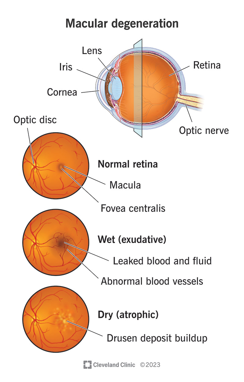 How Do You Fix Macular Degeneration? Low Vision Aids