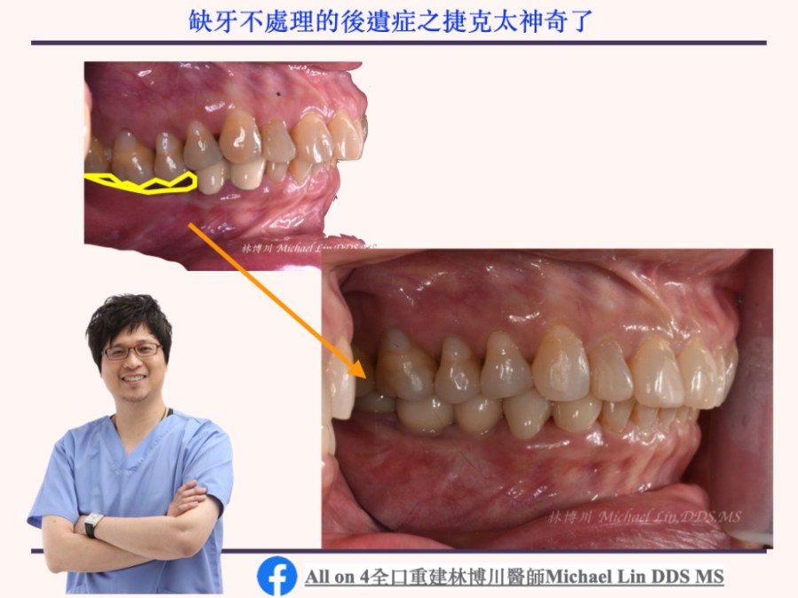 長期缺牙不處理會有什麼後遺症呢？之傑克真是太神奇了，牙齒被頂回去了！案例二