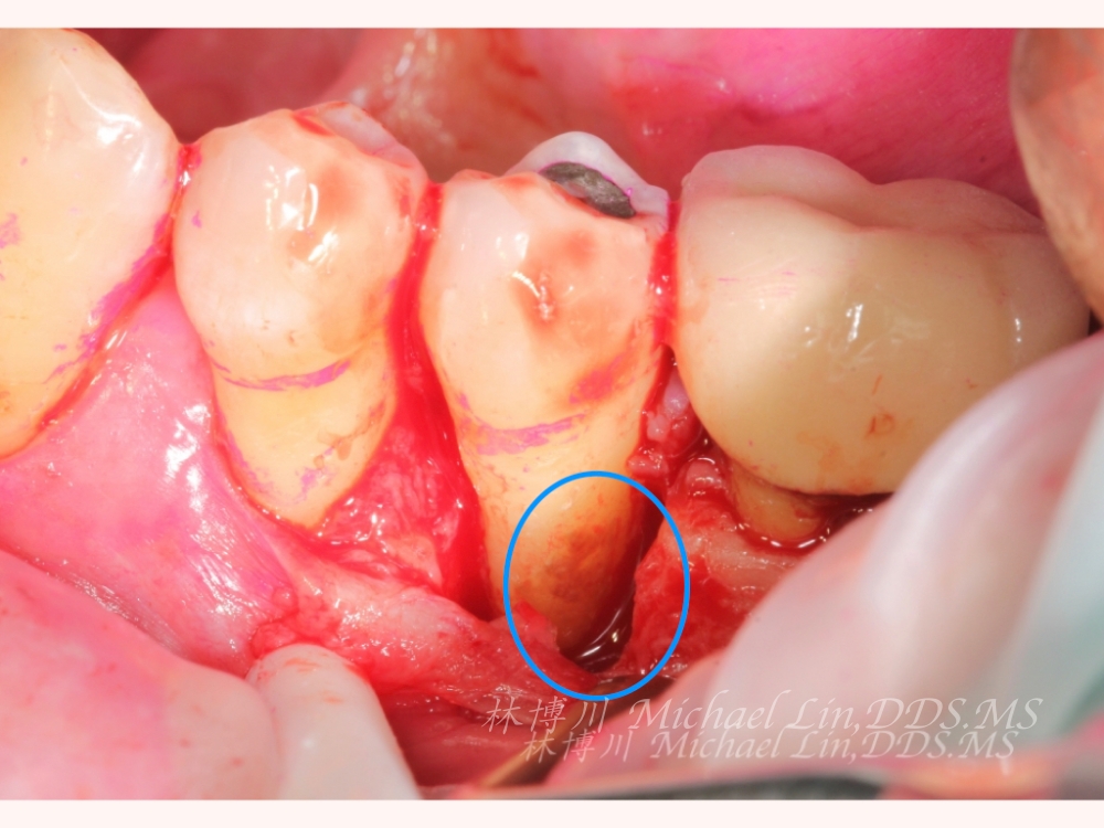 暗藏玄機-牙周再生手術