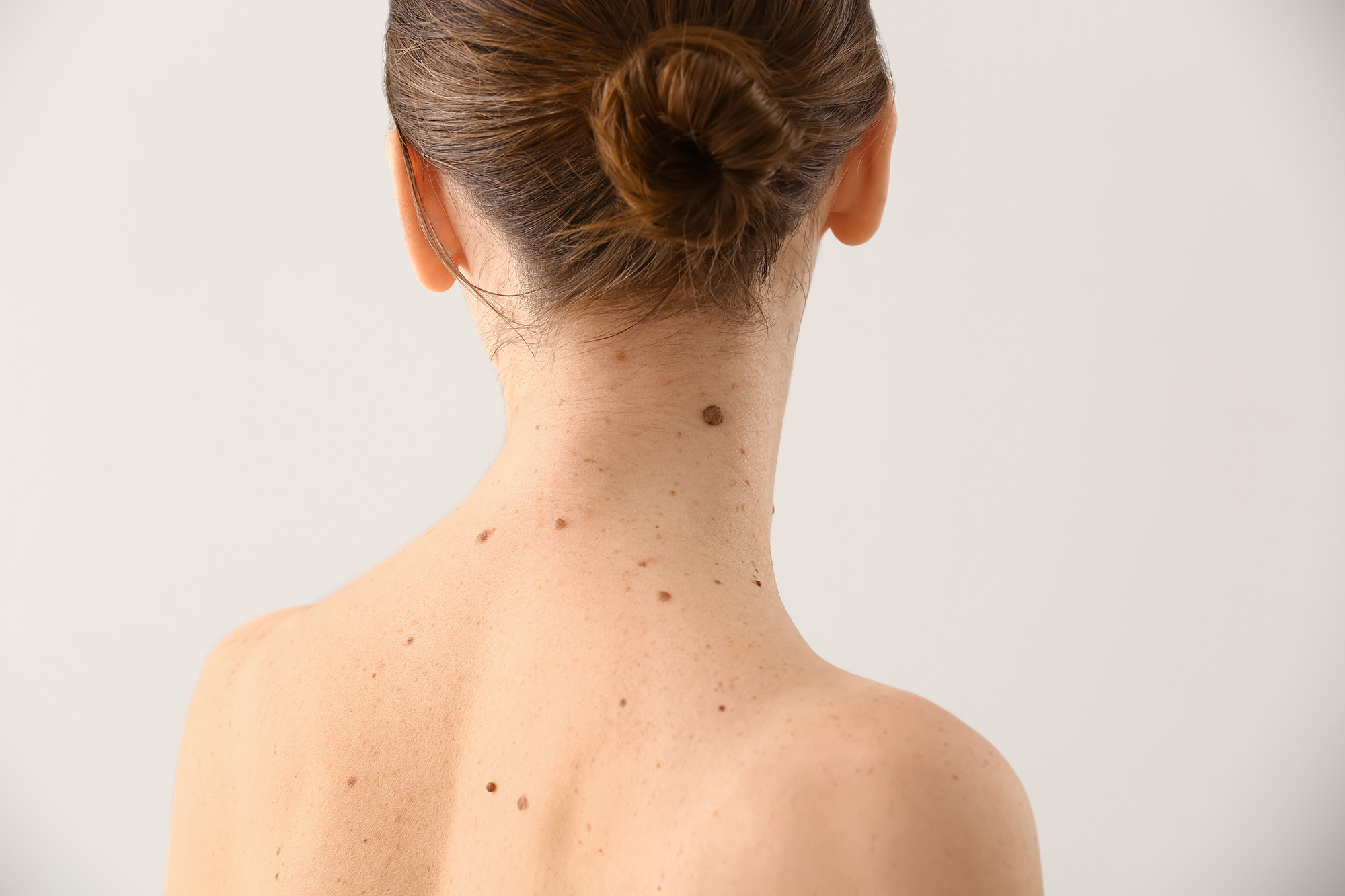 Skin Tags and Moles Edmonton Lucere Dermatology