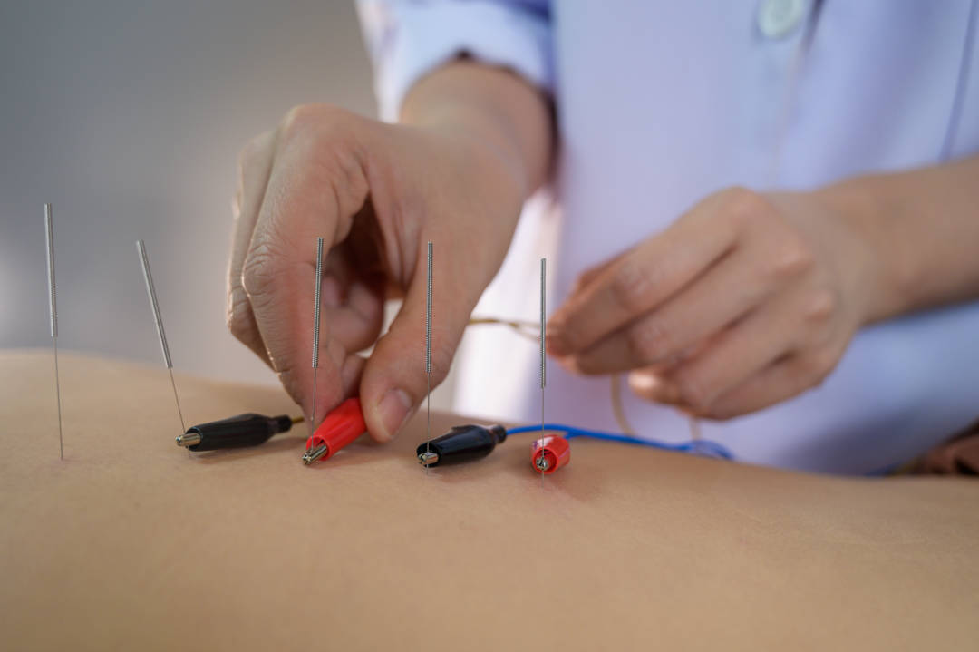 Fertility Acupuncture LuluJay Physiotherapy