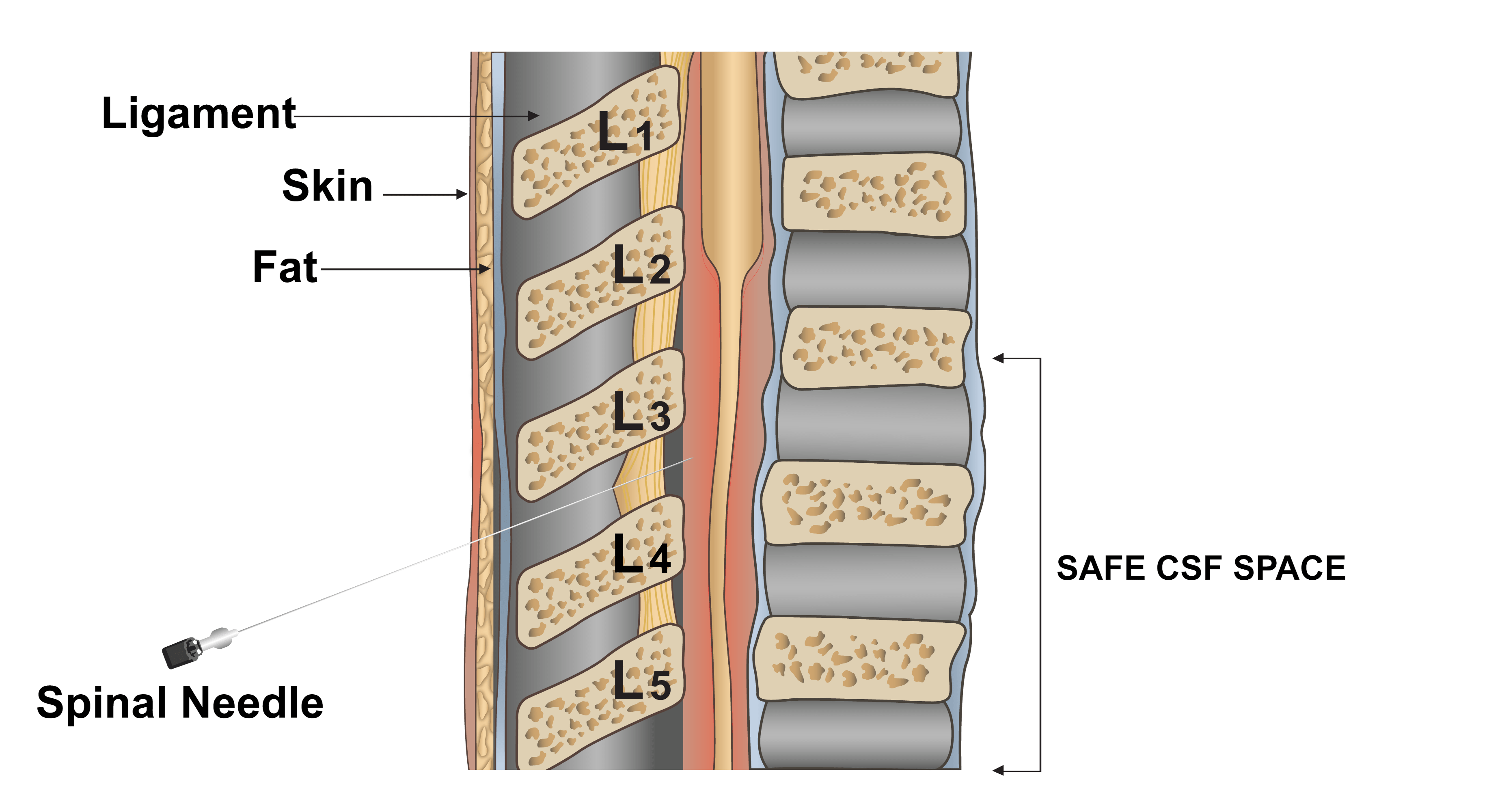 Lumbar Puncture Needle Types