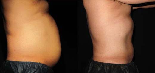 Smart Lipo Philadelphia, PA Laser Lipo Smartlipo 360