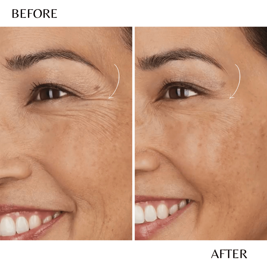 Treatment of Crow's Feet Wrinkles Medical Spa Botox Laser Hair Skin
