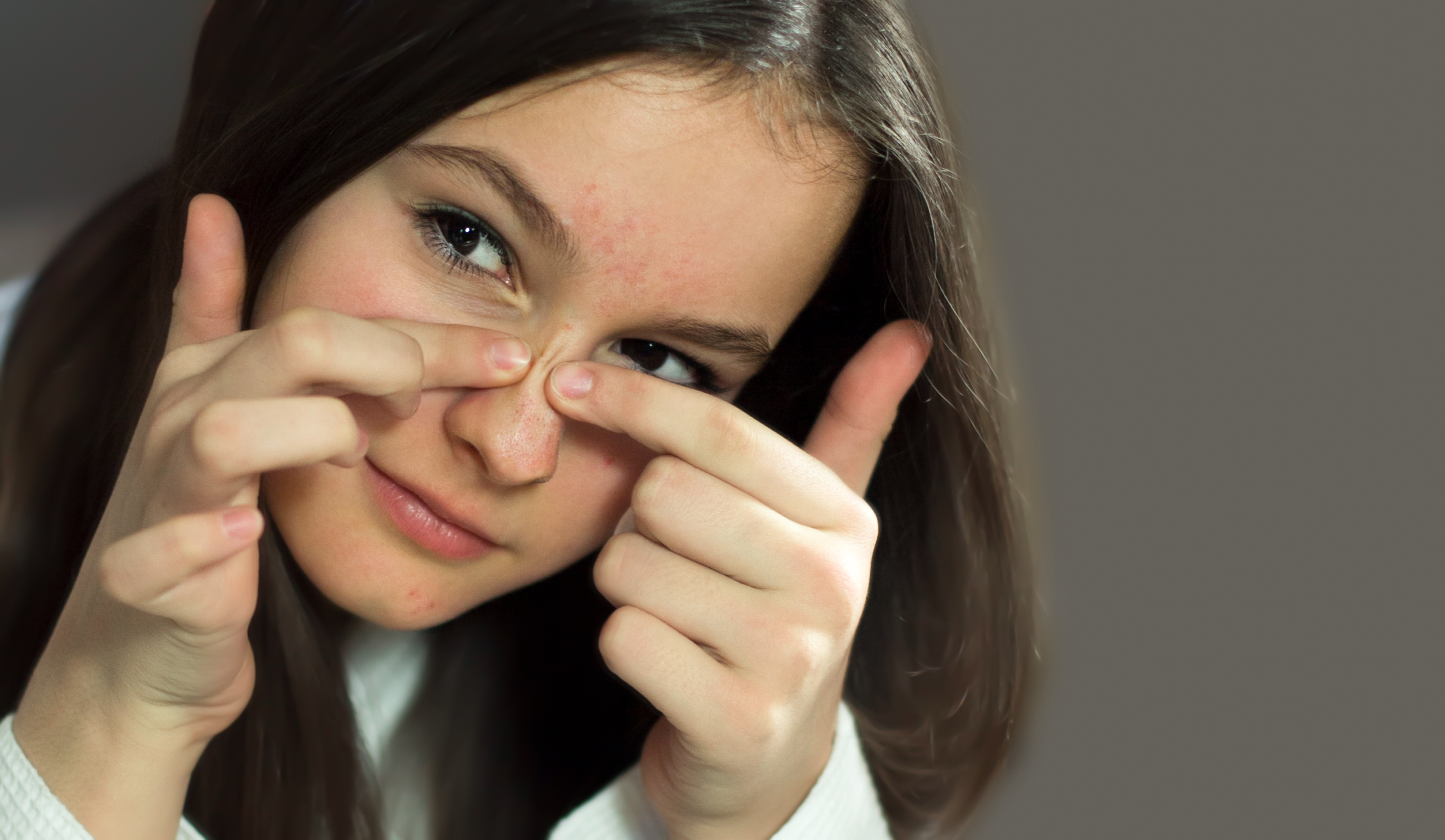 Acne Scar Treatment Toronto Lunae Cosmetic Clinic