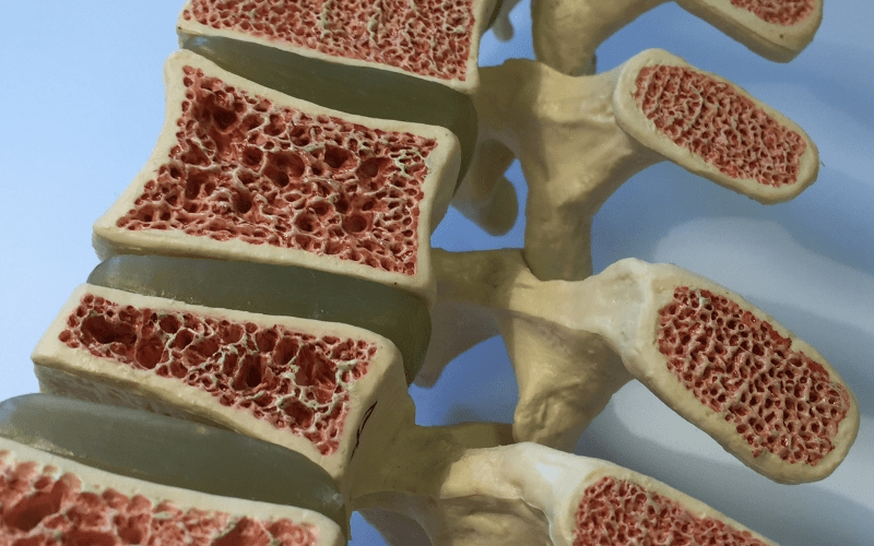 Osteoporosis and Diagnosis