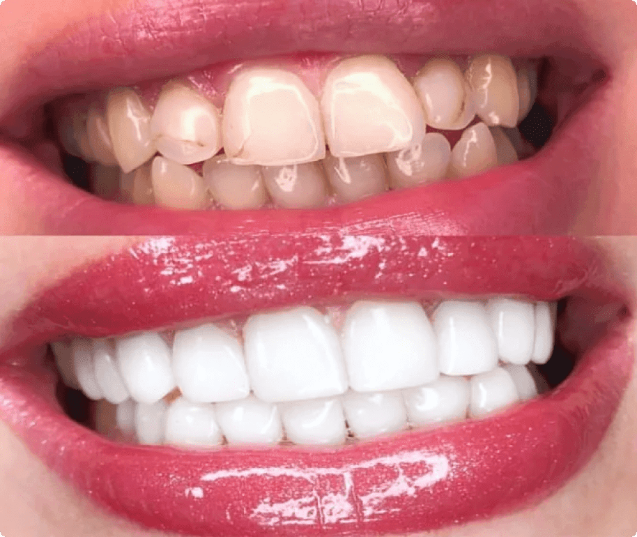 Teeth Cleaning in Brooklyn, NY Dentist Tooth Cleaning