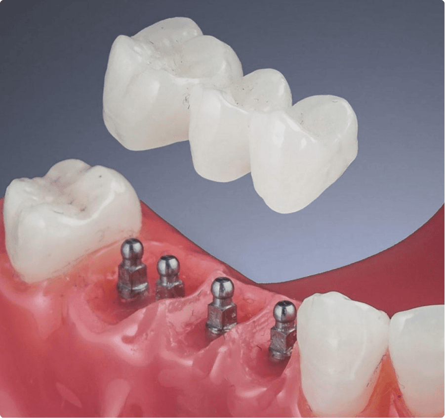 Mini Dental Implants LuxDen Dental Implants Center Brooklyn NY