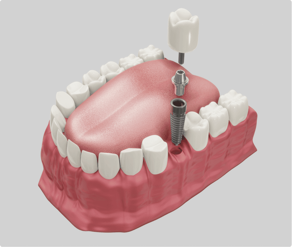Front Tooth Implant Dental Implant Front Tooth in Brooklyn NY