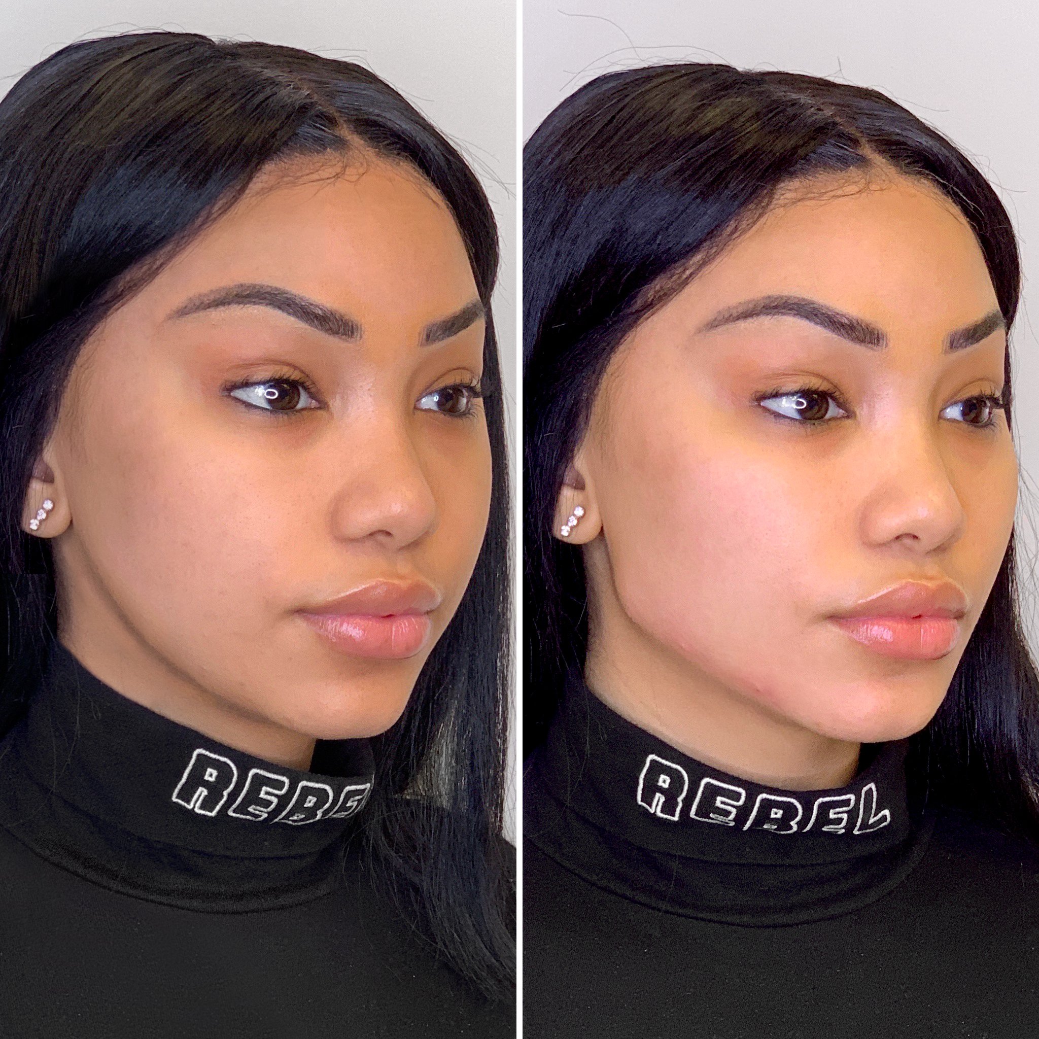 PDO Jawline / Jowl Thread Lift in Clearwater, Florida