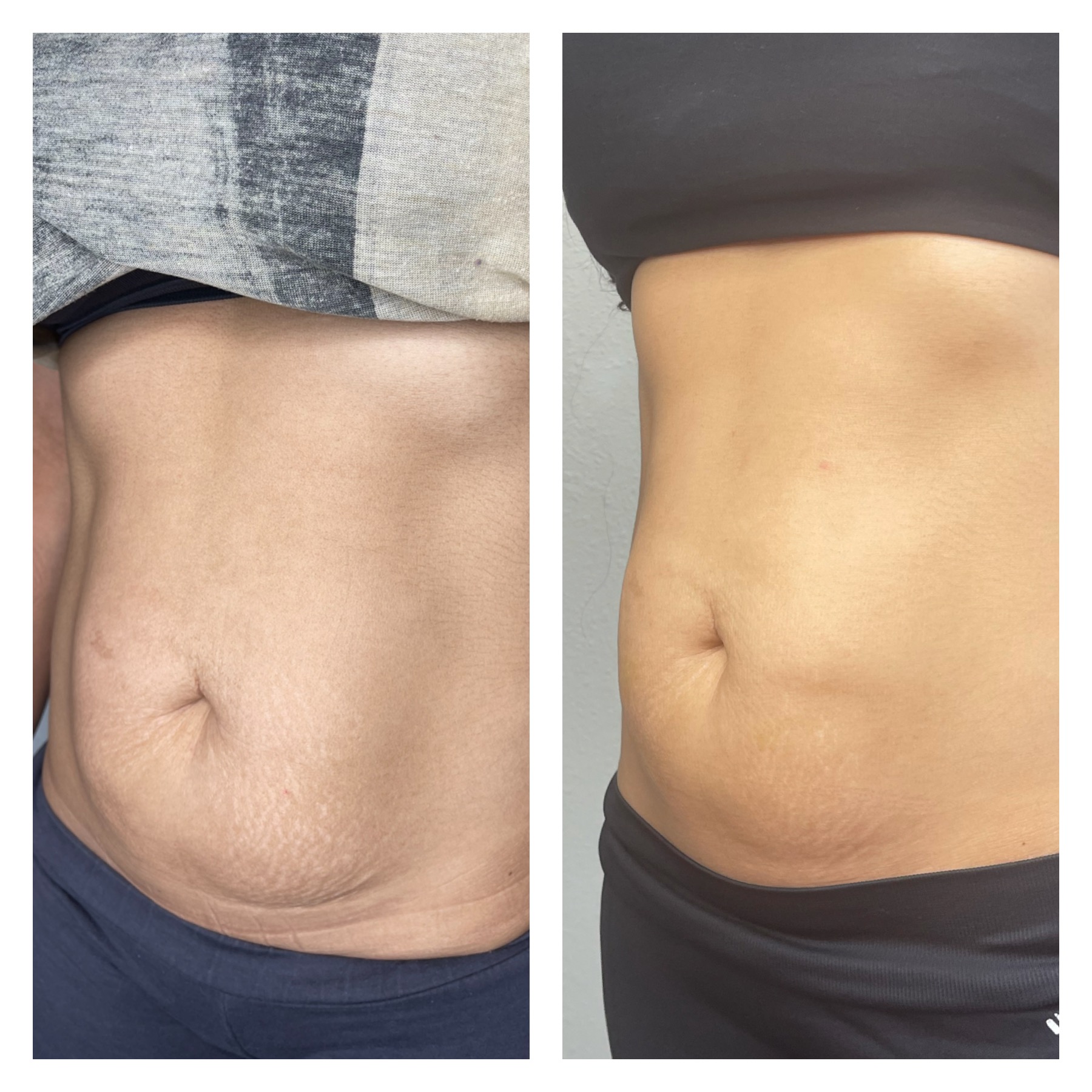 PDO Stomach Lift in Clearwater & Nearby Cities in FL