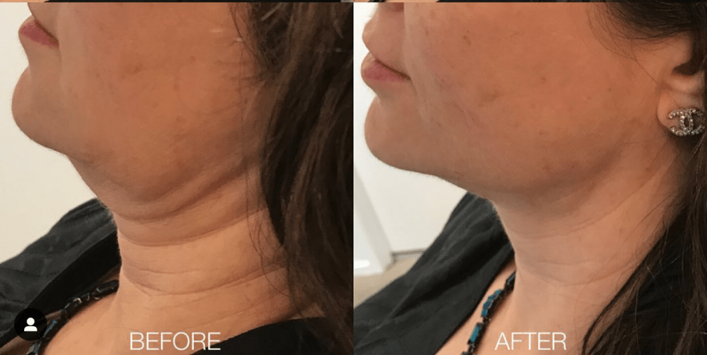 How is PDO Thread Lift Beneficial for Face Tightening? Lux Injectable