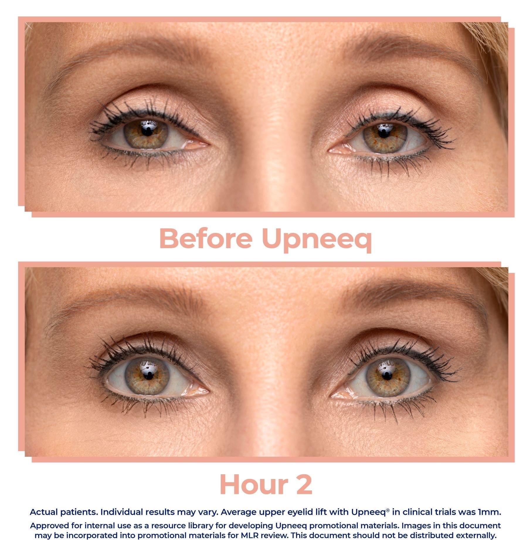 Upneeq Eyelid Lifts NEW! • Luxura Med Spa Chicago