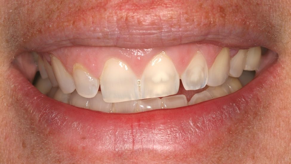 Canted Smile Guide 7 Reasons for the Unaesthetic Canted Smile and What