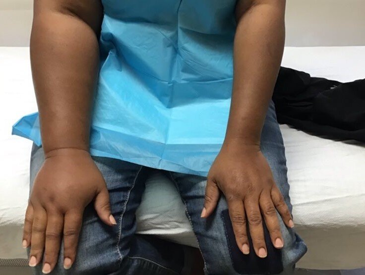 Tips For Lymphedema In Hand And Arm Lymphedema Therapy Specialists