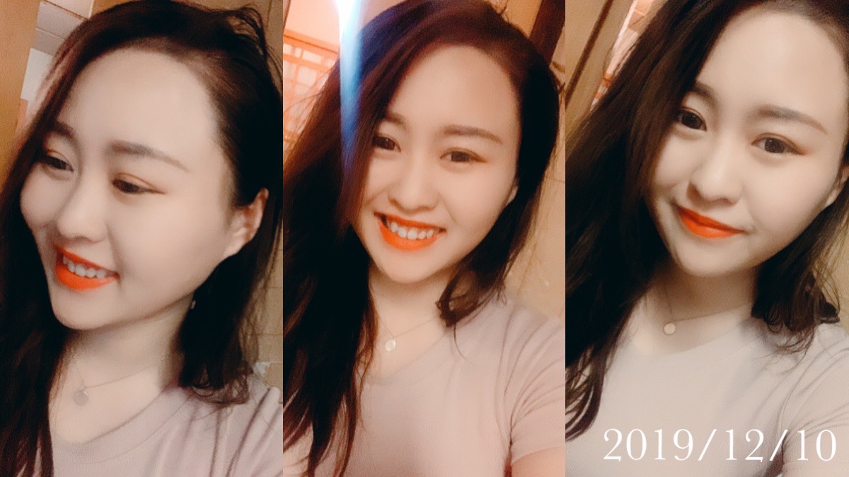 台中 仙杜瑞拉整形外科診所｜縫雙眼皮紀錄