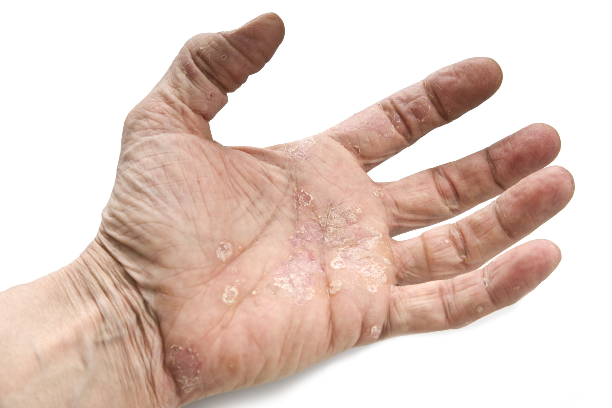 Psoriasis on the Hands and Feet MFolia