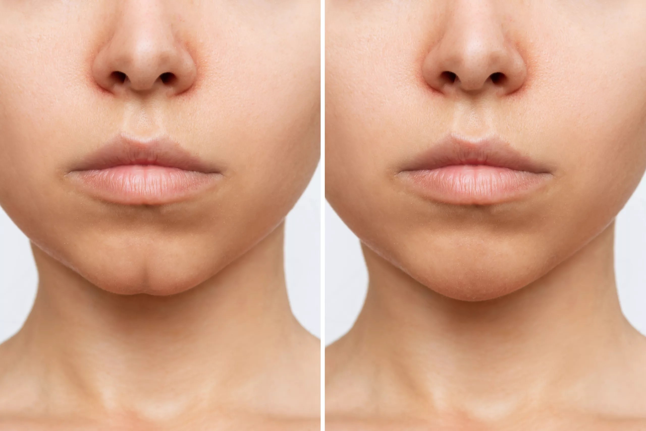 5 Things You Should Know About Dimpled Chin Correction