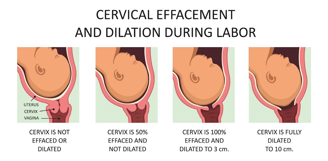 Common Methods of Inducing Labor During Pregnancy MacArthur Medical