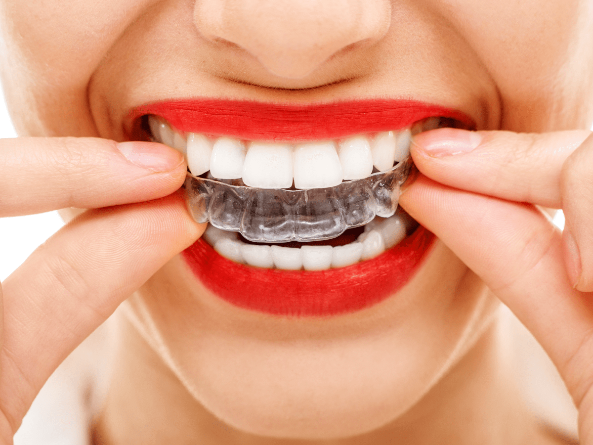 Can Braces Affect Your Singing? Mad Love Records