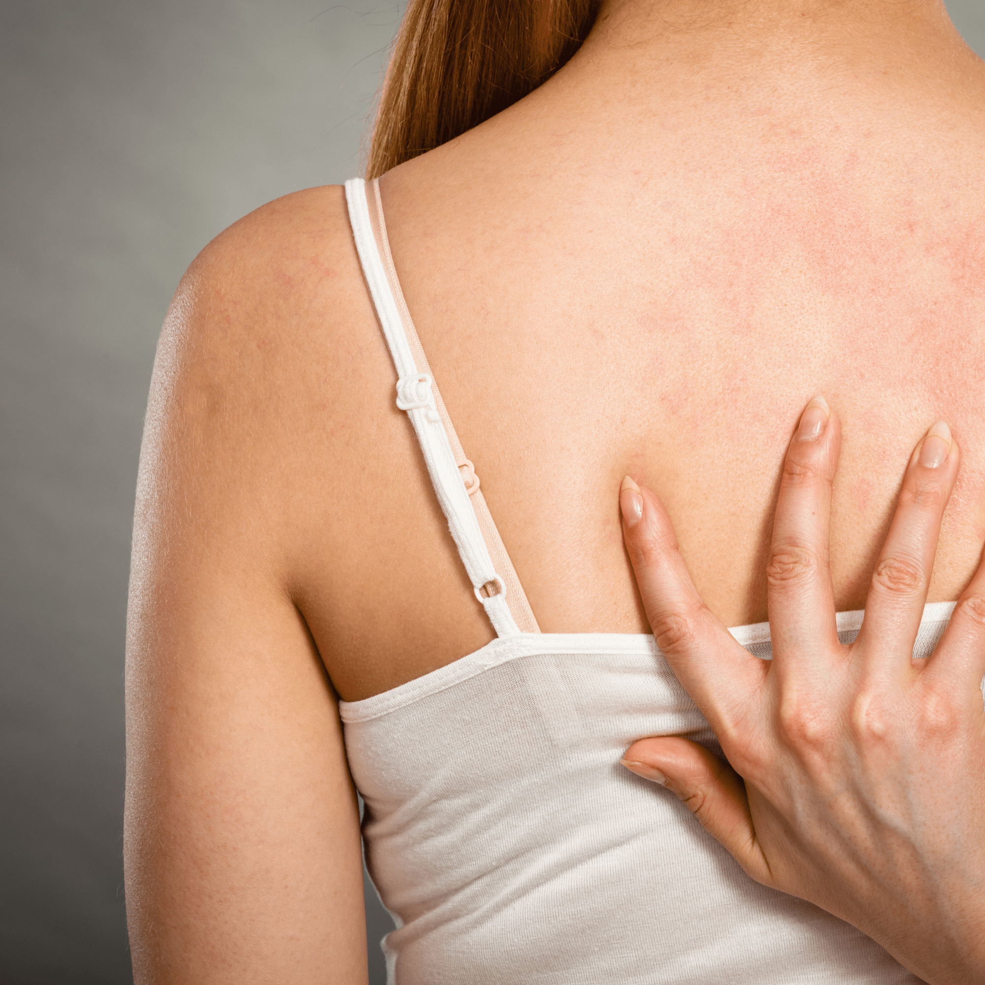 Does hot water worsen seborrheic dermatitis?