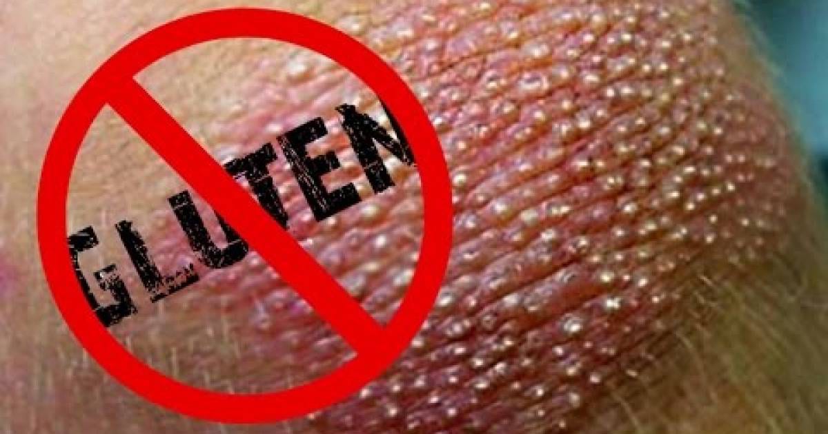 Some Common Signs Of Gluten Intolerance Most People Aren't Even Aware Of