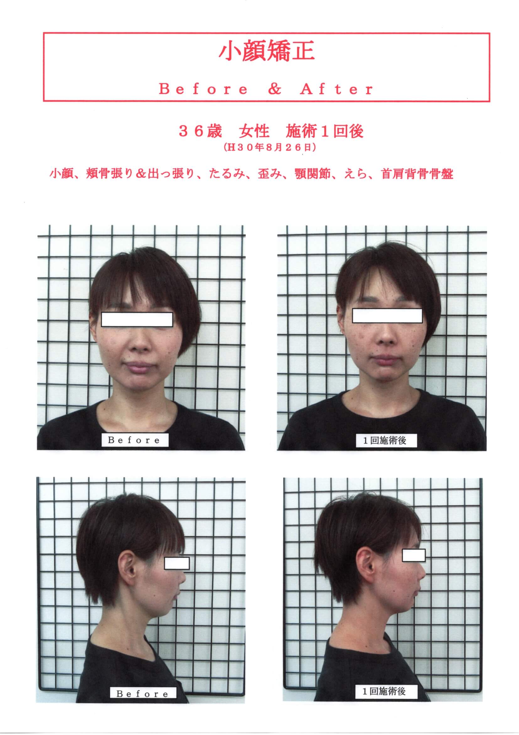 貴女も小顔美人に！！小顔矯正""