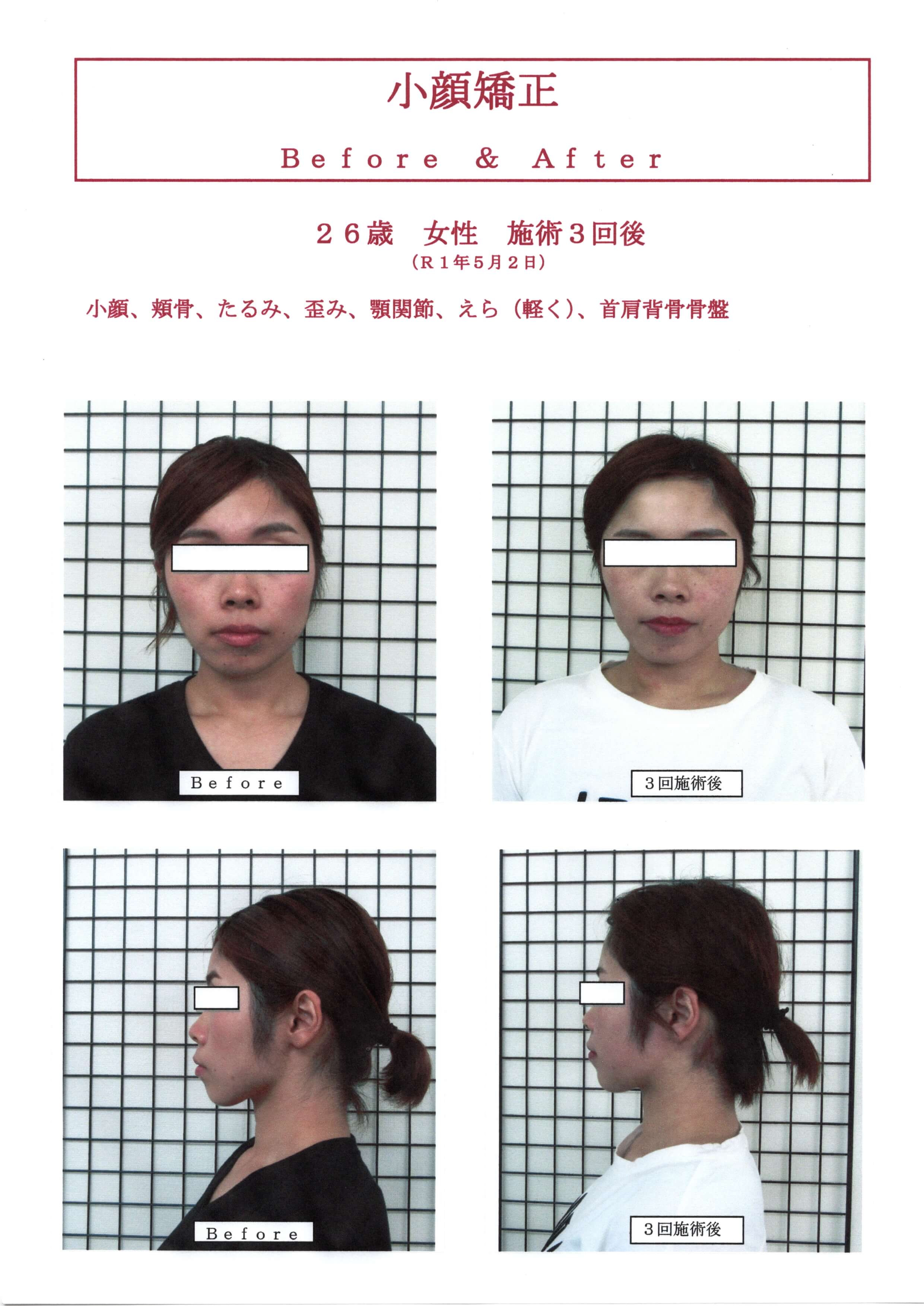 痛くないと人気の小顔矯正SP!