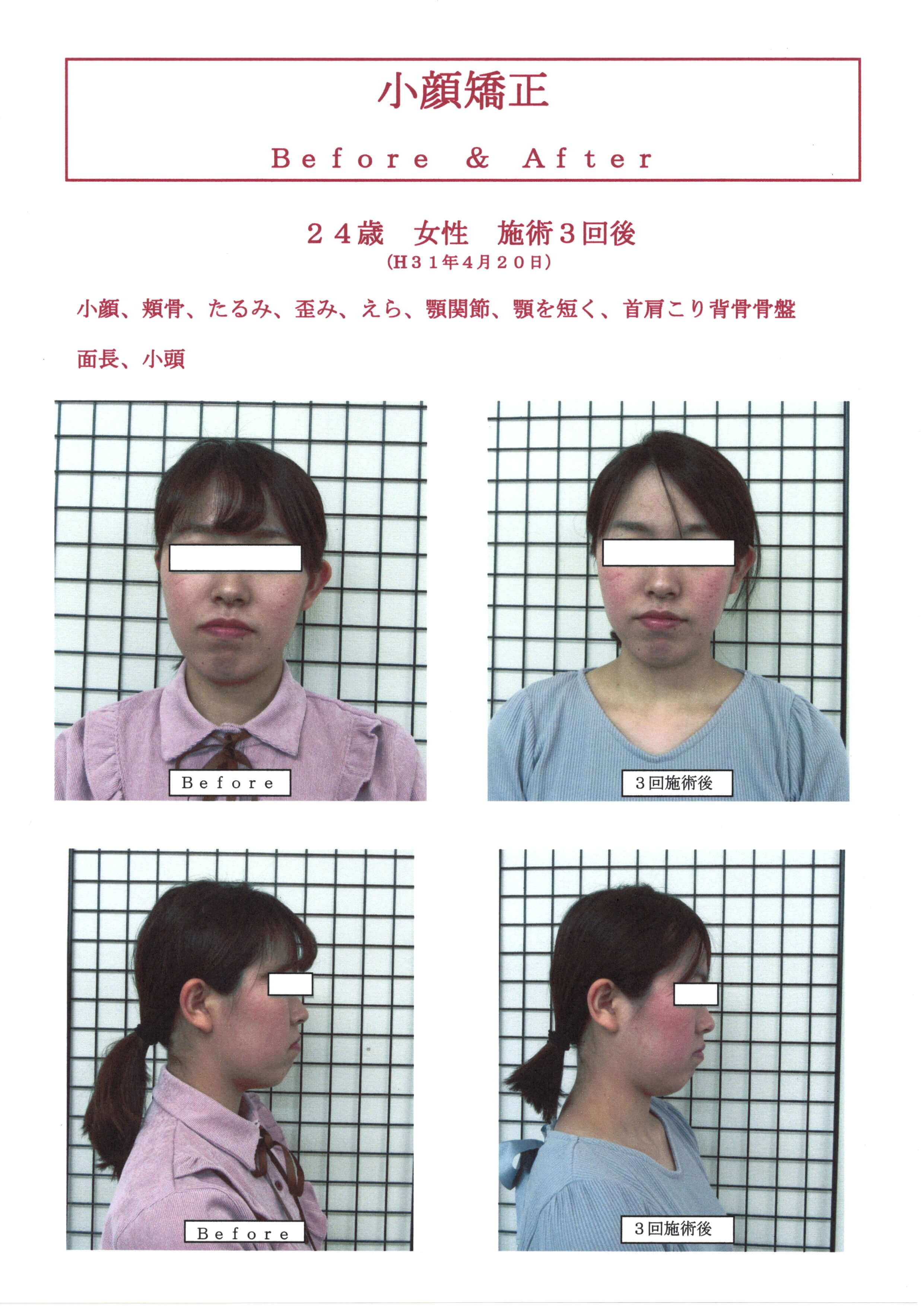 女子会にもお勧め小顔矯正！