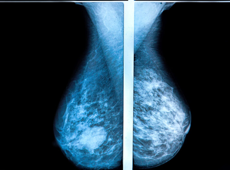What Does Breast Density Mean?