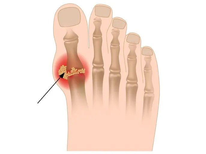 عقار جديد لعلاج النقرس لاول مرة منذ 40 عام