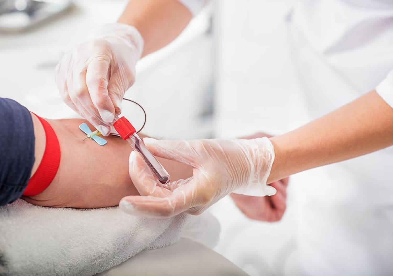 تجربتي مع الفصد