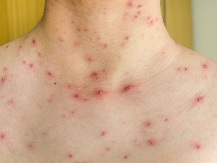 مدة مرض الجدري المائي عند الكبار