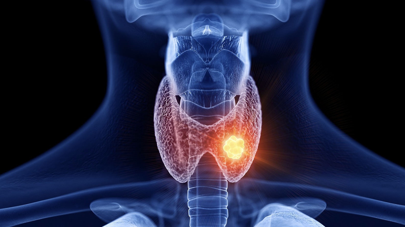 تجربتي مع هاشيموتو