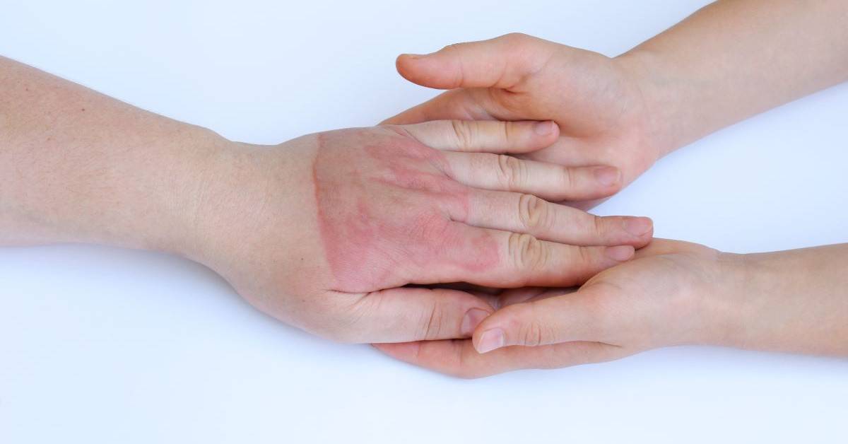 Phytophotodermatitis Foods that can lead to sunburns