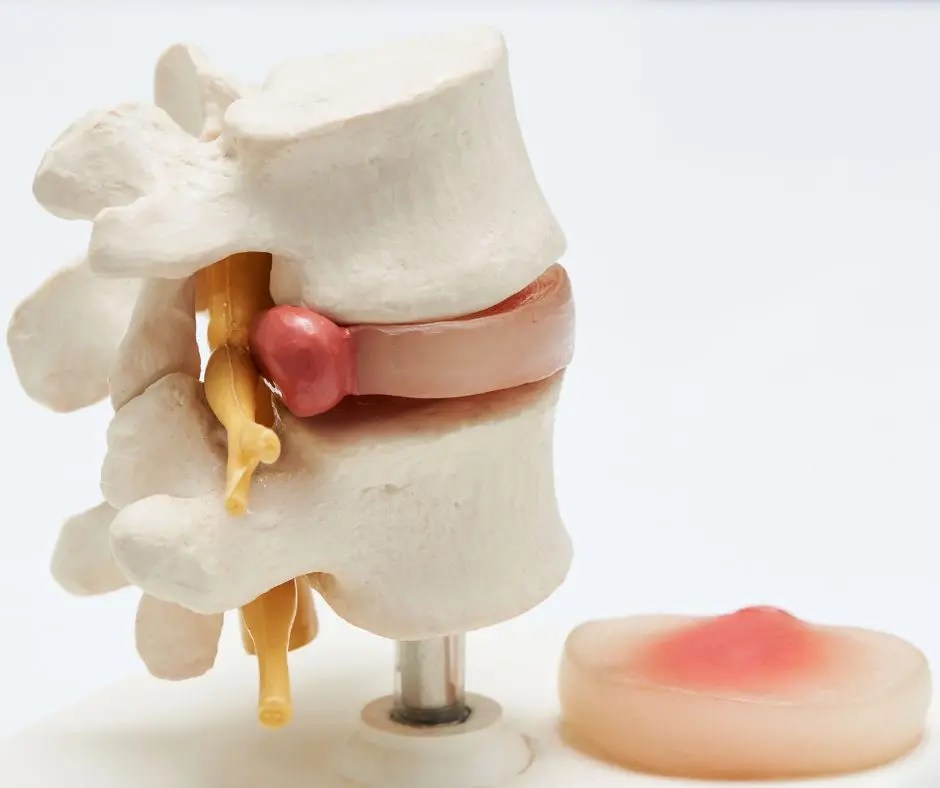 Relieve Lower Back Pain Effective Exercises for Bulging Disc in Lower