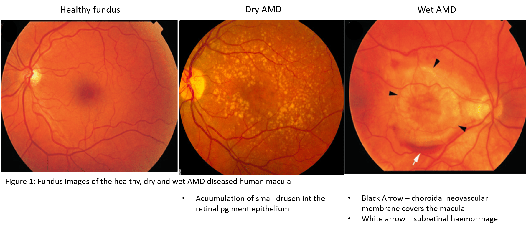 Predictive biomarkers and new therapeutic targets for Agerelated Macular Degeneration (AMD)