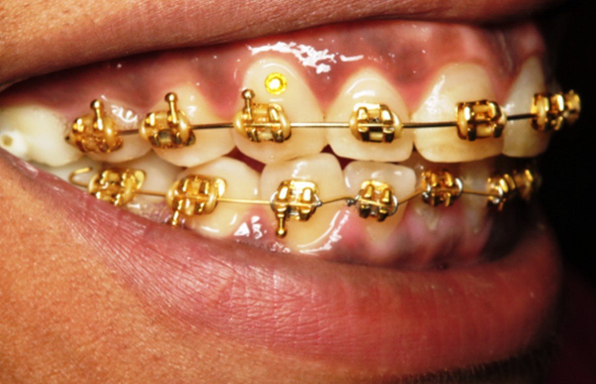 The Pros And Cons Of Gold Braces Majescor