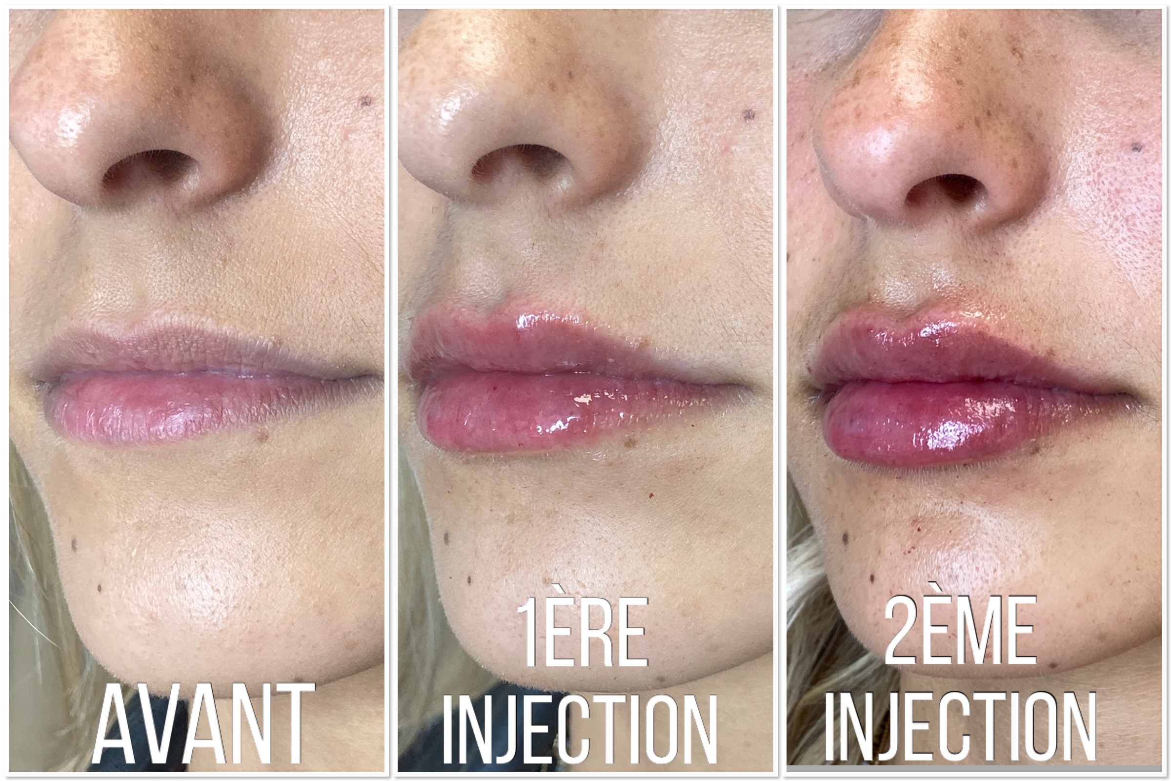 Julie Roux Hyaluron Pen Toulouse Traitement des rides