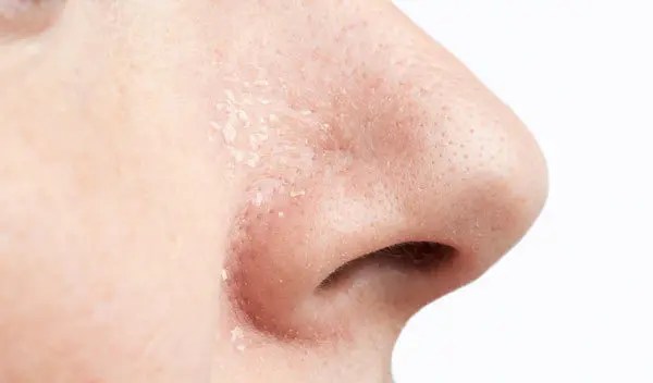 Why Is Your T Zone Dry And Flaky And Cheeks Oily? Makeover Momma