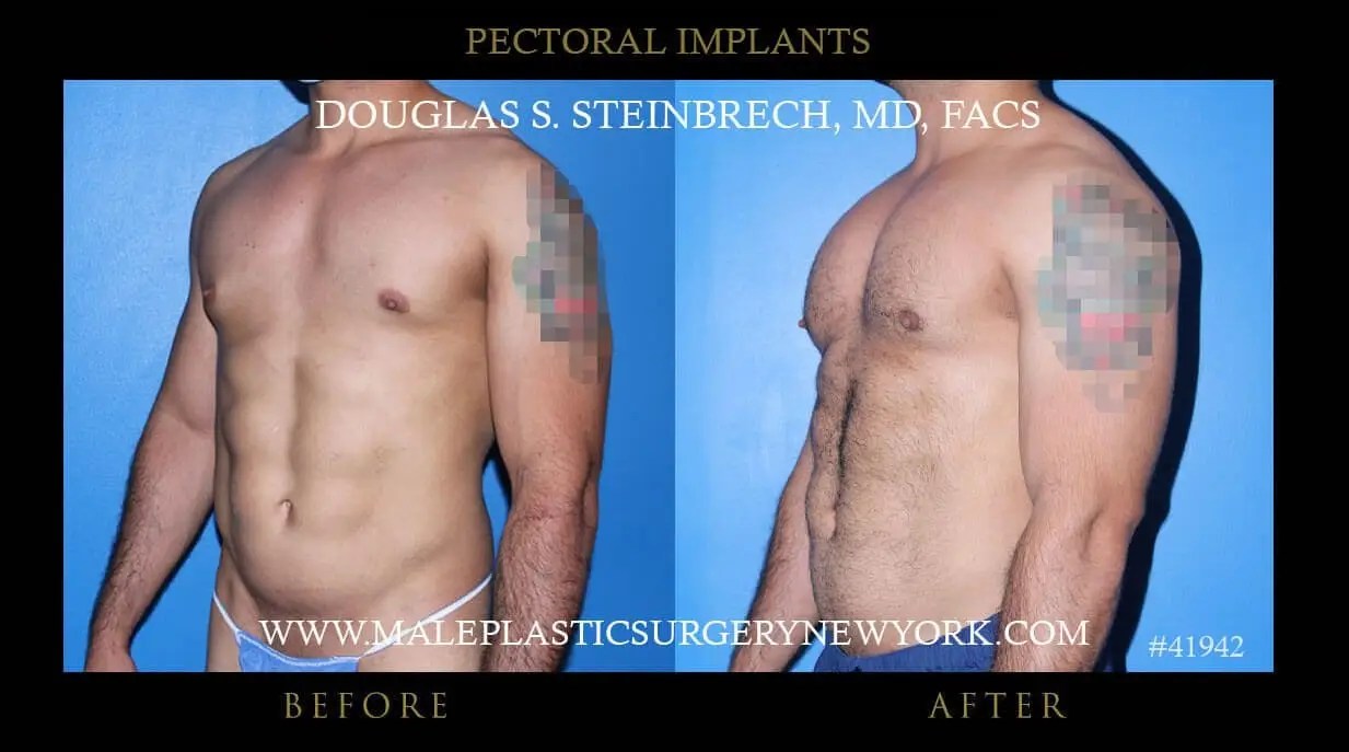 Pec Implant Gallery Explore Enhanced Chests
