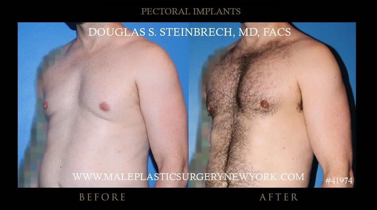 Pec Implant Gallery Explore Enhanced Chests