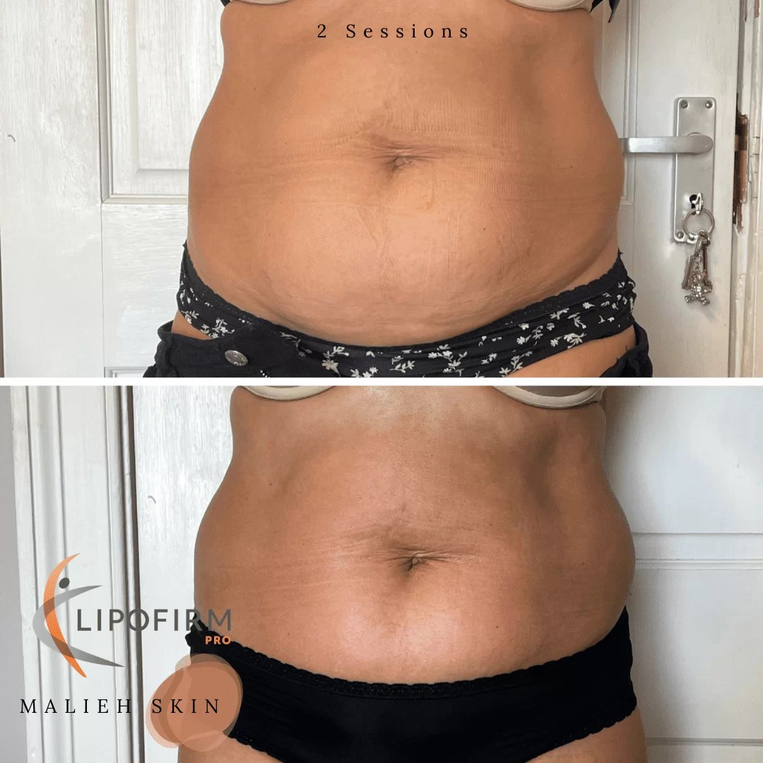 Lipofirm Pro Malieh Skin