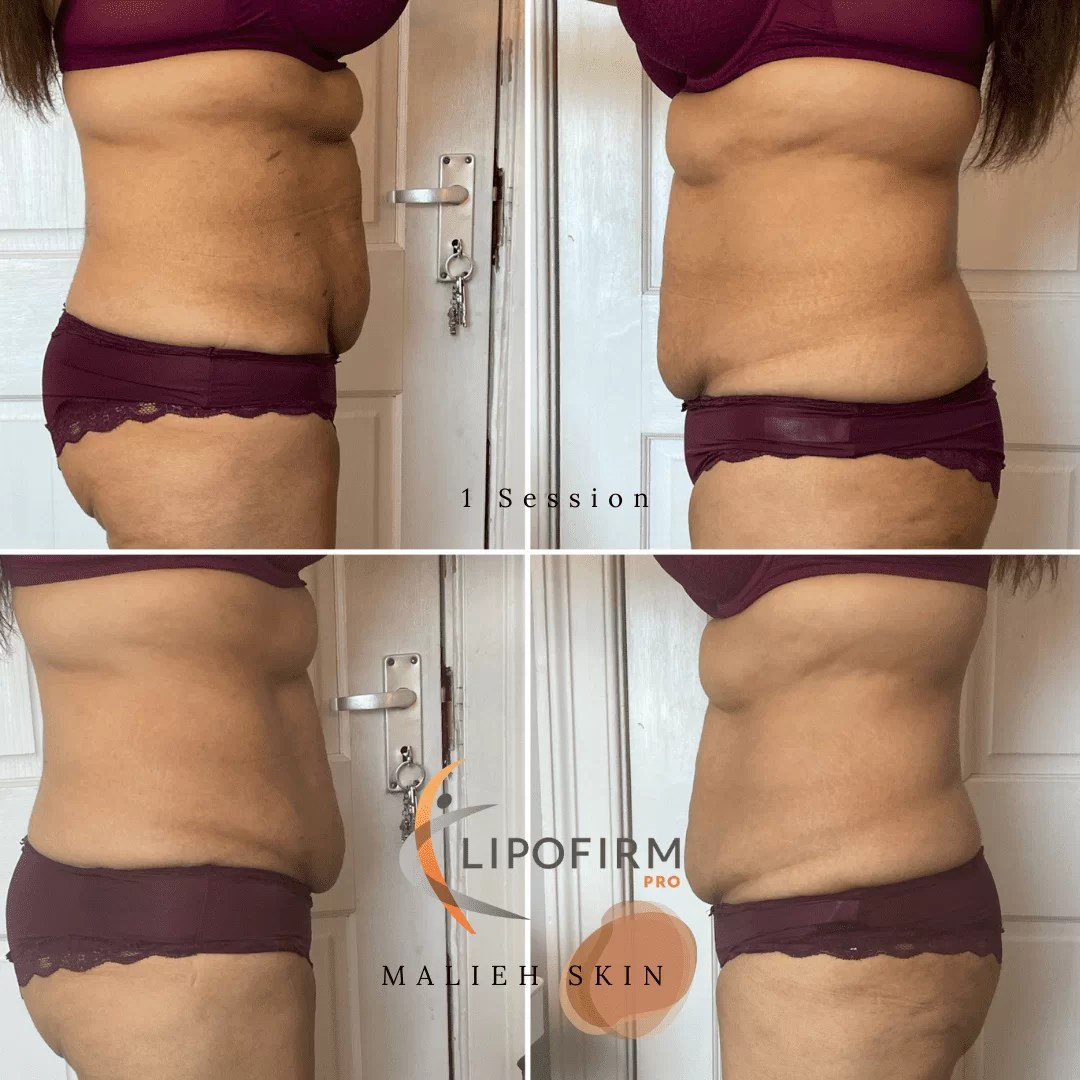Lipofirm Pro Malieh Skin