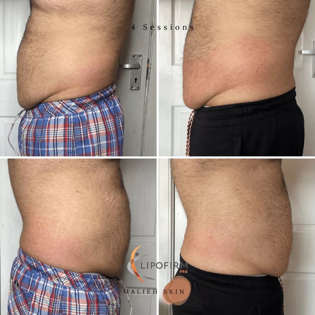 Lipofirm Pro Malieh Skin