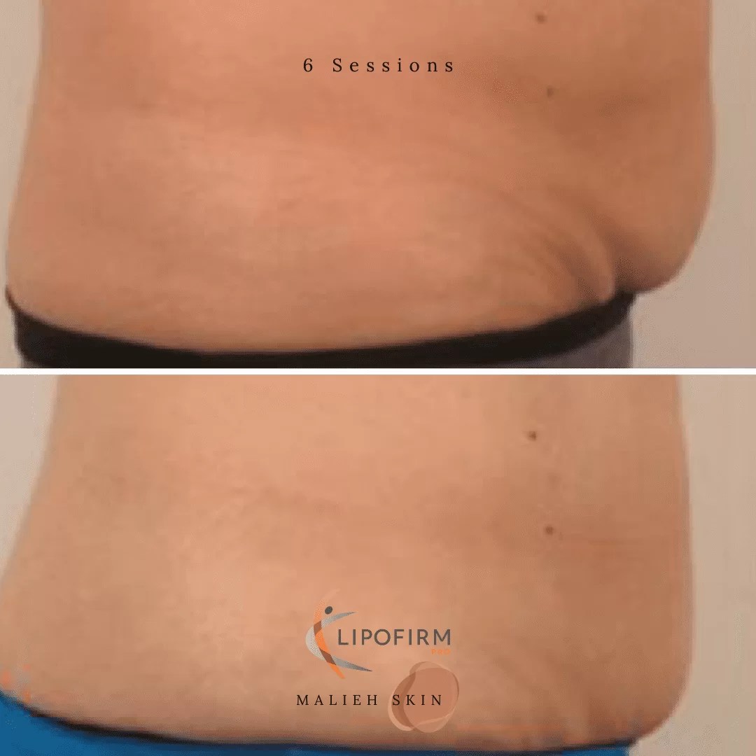 Lipofirm Pro Malieh Skin