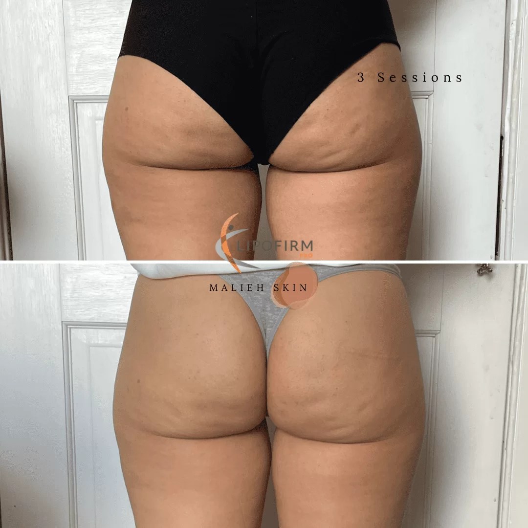Lipofirm Pro Treatment for your bum, tum and cellulite!